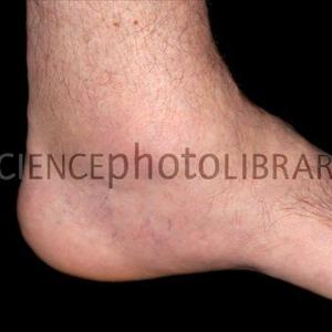 Apple Cider Vinegar Gout Cure - Ascorbic Acid A Possible Cure Intended For Gout