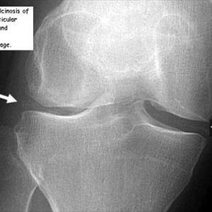 Build Up Uric Acid - Avoiding Gout With Milk And Water