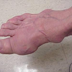 Oxalic Acid In Big Toe Joint - What You Need To Know Concerning Gout