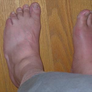 List Foods That Can Be Eaten When One Suffers From Gout - Diet For Gout Sufferers - Safe And Helpful Tips