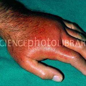 Does The Acid In Grapefruit Cause Arthritis In Fingers To Pain - What Goes On In Case The Cure Therapy Neglects In Tophaceous Gout