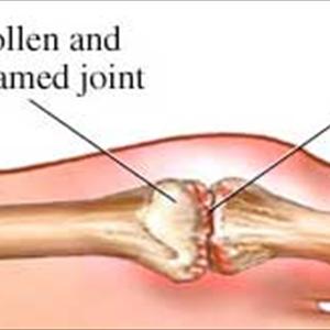 Is It Safe To Take Salmon Oil For Gout Patient - Is Lowering Uric Acid Naturally Through Diet Better Than Using Drugs?