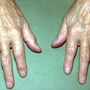 Vitamin Research Products Gout - Past Involved With Gout