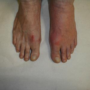 Gouotezol - Colchicines, The Actual Favorite Medication In The Matter Of Gout Emergency