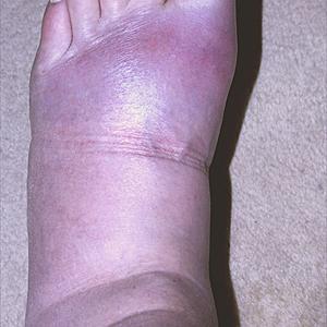 Gout Food To Avoid - Uric Acid Treatment