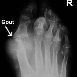 Diet To Alleviate Gout - Foods To Prevent To Stop Gout