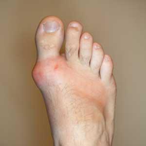 Foods That Lower Uric Acid Levels - Tips Upon Protecting Against Gout