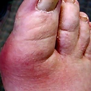 Gout Cures - Discussion About Key Perform Of Vit C In Alleviation Of Gout