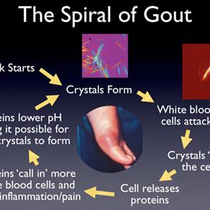 Relieving Gout In Your Big Toe - Gout Symptoms, Treatment And Natural Home Remedies