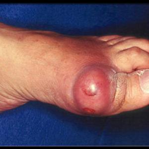 Gout Pain Remedy - Natural Tips To Eradicate Gout Symptoms