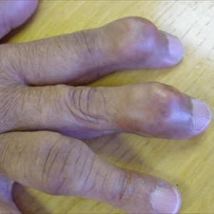 Febuxostat Cost - The Signs Of Gout: Information In Relation To It