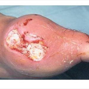 Strawberries And Uric Acid - Tips And Tricks To Prevent Gout Illnesses