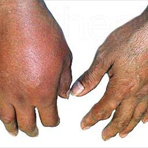 Uric Acid Salmon - High Uric Acid Symptoms Exactly How An Boost In Uric Acid Can Cause Gout