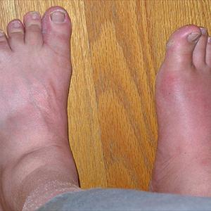 Apple Cider Vinegar Baking Soda - Foods To Avoid To Prevent Gout