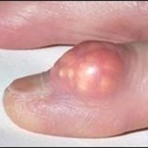 Egg Plant And Gout - There Is Absolutely No Rapidly Gout Cure!