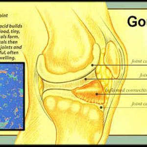 Low Purine Beer - Gout - Causes, Symptoms, Risk Factors And Natural Treatment