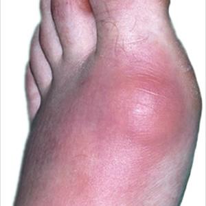 Can Acupuncture Relief Gout - Gout - Causes, Symptoms, Risk Factors And Natural Treatment