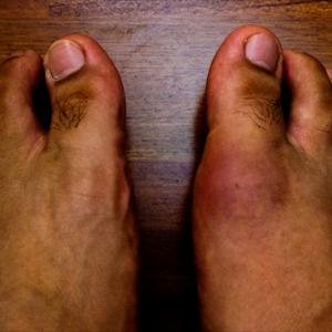 Tophi Gout - Find Relief For Gout Troubles