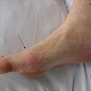 Problems With Foot After Gout Surgery - Can Magnet Therapy Relieve Gout Pain?